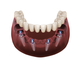 Chicago IL Dental Implants