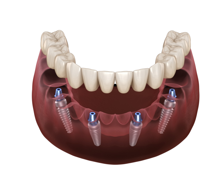 full-arch-dental-implants-768x591